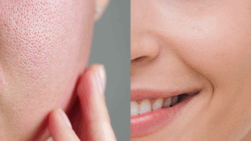 Poros Dilatados? Conheça os 3 melhores produtos para a solução desse dilema!