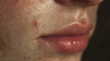 Imagem de uma mulher com espinha acima da buchecha