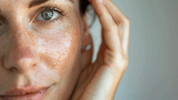 Imagem gerada por IA de mulher com melasma no rosto