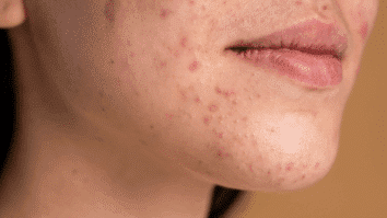 Mulher com espinhas presentes na pele