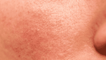 A imagem mostra uma pele com poros dilatados, culminando em uma textura irregular